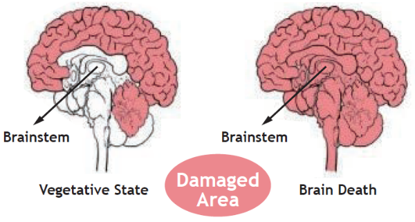 blog.naver.com/ The criterion to distinguish these two states is the damaged area of the brain, especially whether the brainstem is damaged or not.