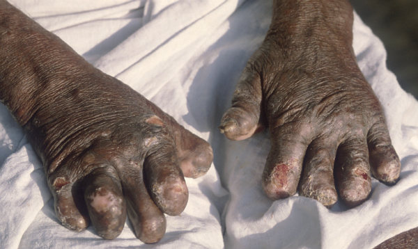 Wikipedia/ Symptom of Leprosy